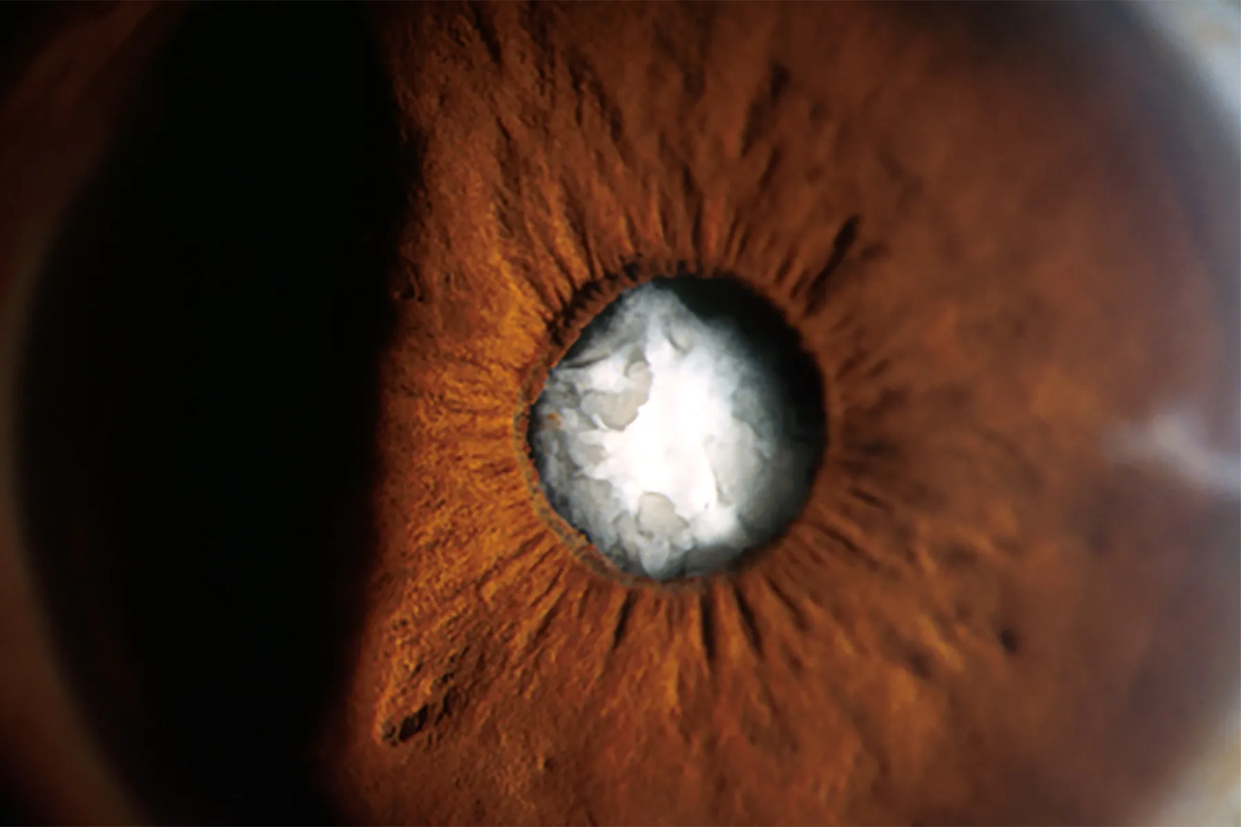 Cataract Surgery Tricky for Those With Past Radial Keratotomy
