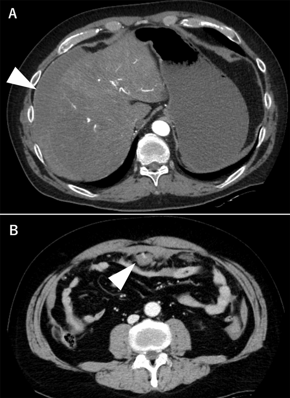 Single-Organ Vasculitis Following COVID-19 Infection Resulting in Visceral Arterial Rupture: A Case Report