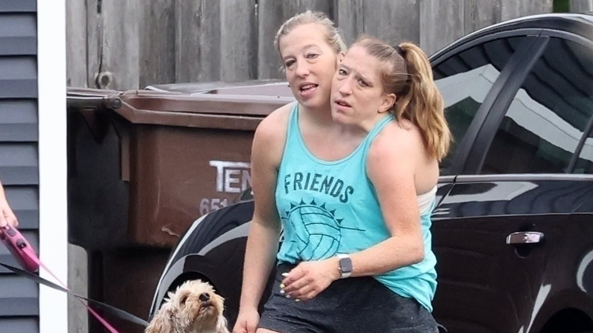 Conjoined twins seen after newborn outing