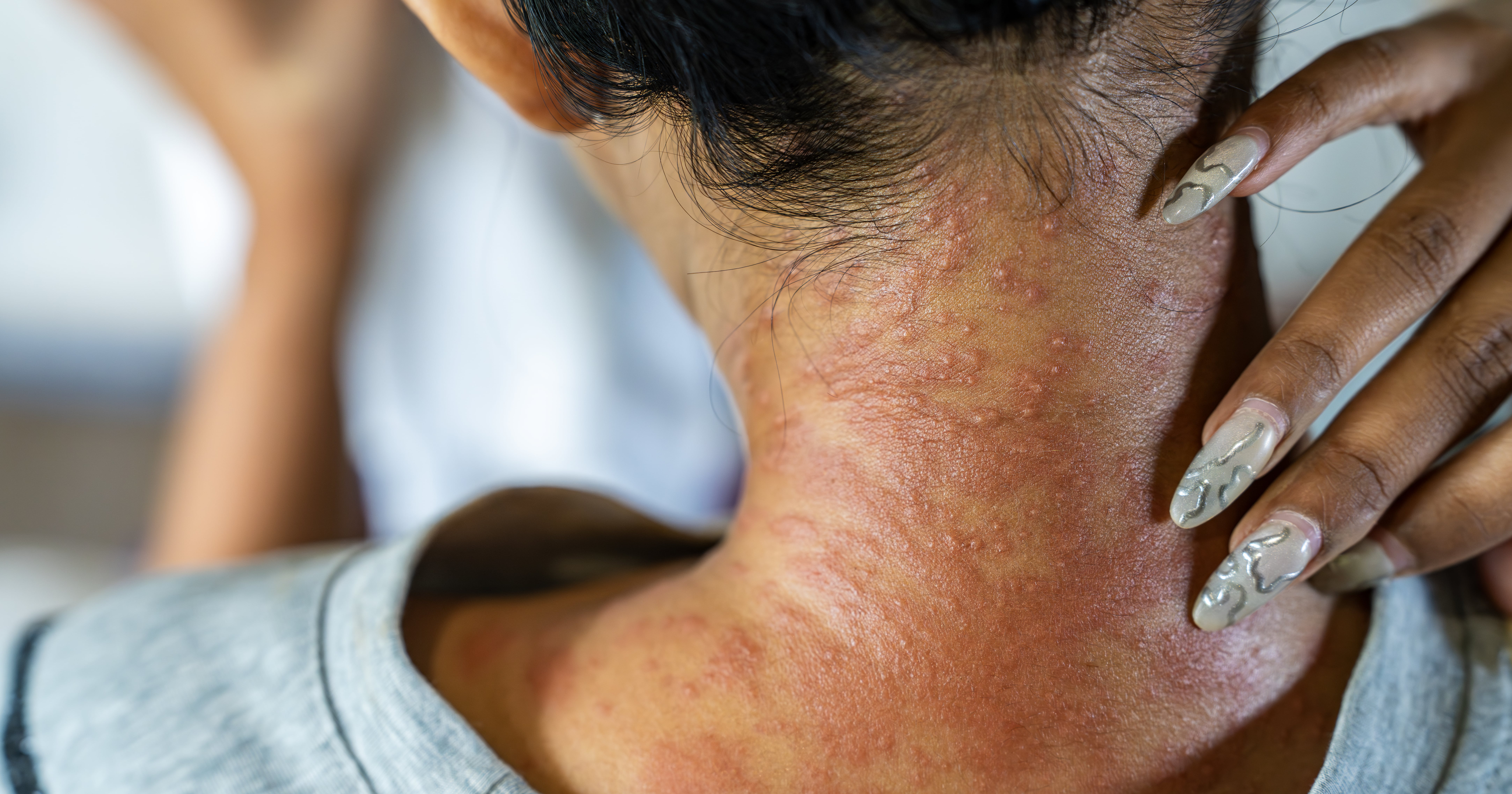 Eczema Is More Common Than You Think - Here's Everything to Know