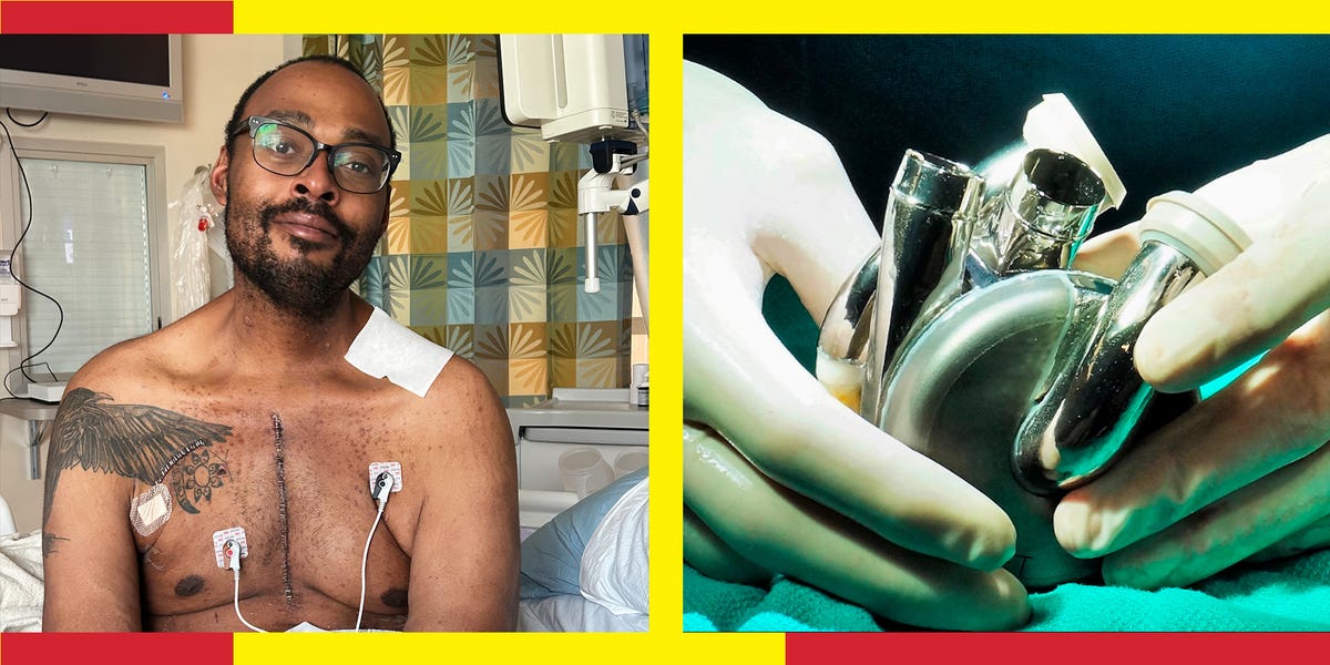 I Survived a Rapidly Failing Heart. My Lifesaver: A Titanium Ticker.