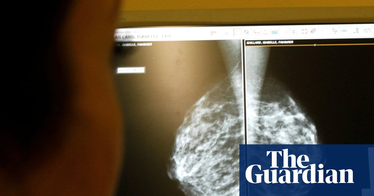 AI use in breast cancer screening cuts rate of later diagnosis by 12%, study finds