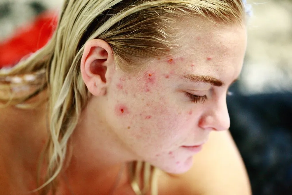The Different Tiers of Adult Acne Treatment