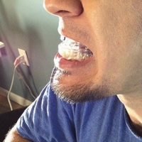 mouthguard australia